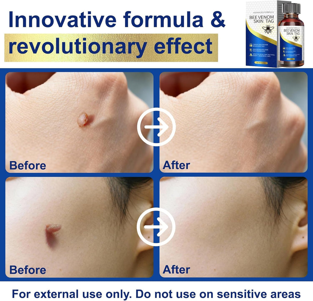 TWICETWO Fast-Acting Skin Tag Remover (30ml)